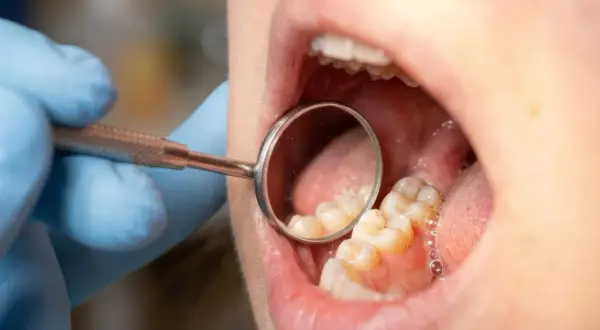 Dentysta bada zęby, szukając próchnicy między zębami. Widać odbicie zębów w lusterku dentystycznym.