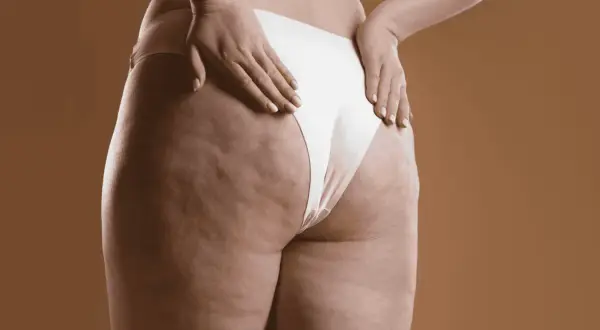 Dettaglio della coscia e del gluteo con cellulite, un'immagine che stimola la riflessione su come eliminare la cellulite e migliorare la propria pelle.