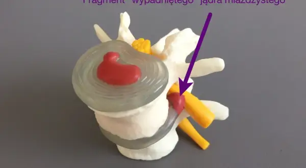 Model kręgosłupa z wypadniętym jądrem miażdżystym, wskazującym na potrzebę zaleceń po nastawianiu kręgosłupa.
