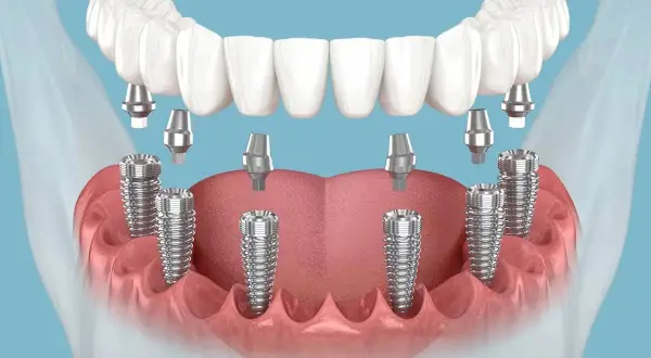 Zęby w jeden dzień cennik: wizualizacja implantów stomatologicznych i protezy górnej szczęki.
