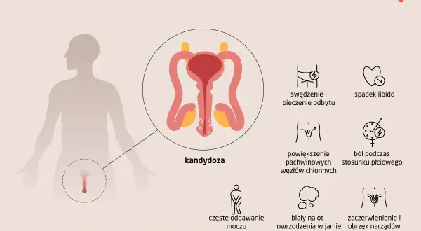 Ilustracja przedstawia objawy kandydozy u mężczyzn: pieczenie, spadek libido, powiększone węzły chłonne, ból podczas stosunku, częste oddawanie moczu, biały nalot w jamie ustnej, zaczerwienienie narządów płciowych.