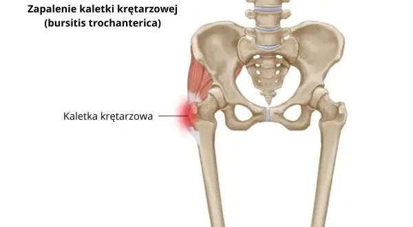 Zapalenie kaletki krętarza większego – ilustracja anatomiczna miednicy i uda z zaznaczonym bolącym obszarem.