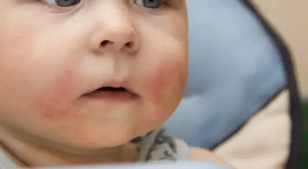 Czerwone, suche policzki dziecka mogą wskazywać na uczulenie na gluten. Twarz malucha jest zaczerwieniona wokół ust.