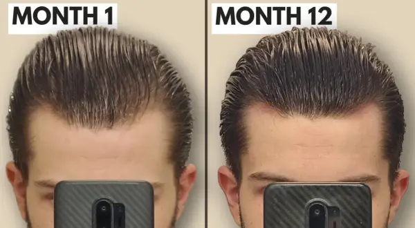Comparaison avant/après 12 mois : le derma roller a visiblement densifié la chevelure et réduit la perte de cheveux sur le front.