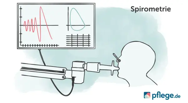 Spirometrie-Diagramm zeigt Lungenfunktion. Bei COPD Gold 3 ist der GdB oft hoch.