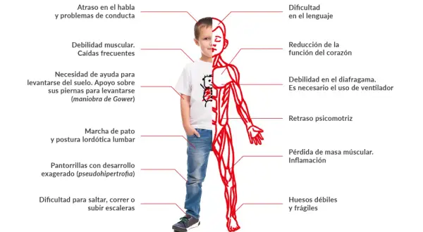 Un niño muestra los efectos de la distrofia muscular de Duchenne: debilidad muscular, problemas de lenguaje, cardíacos y respiratorios, entre otros.
