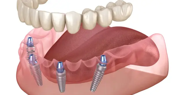Górna proteza zębowa opiera się na implantach wszczepionych w dolną szczękę.