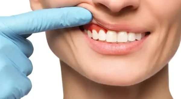Ból zęba? Czerwone, opuchnięte dziąsła mogą wymagać antybiotyku na zęba. Dentysta bada dziąsła.
