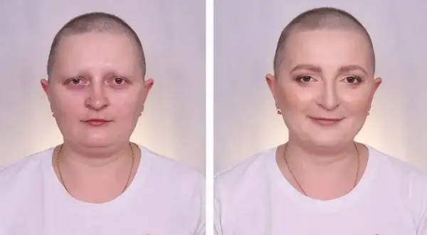 Czy po chemii wypadają brwi i rzęsy? Poznaj prawdę o skutkach terapii