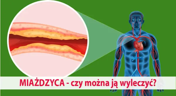 Zbliżenie na zatkaną miażdżycą tętnicę obok sylwetki człowieka z widocznym układem krwionośnym.