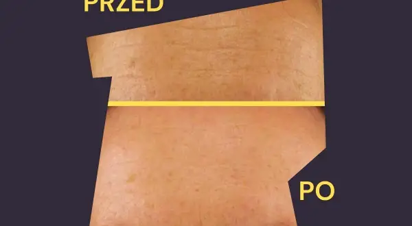 Przed i po zabiegu: skóra z widocznymi zmarszczkami i przebarwieniami staje się gładsza i jaśniejsza. Revibel opinie potwierdzają skuteczność.