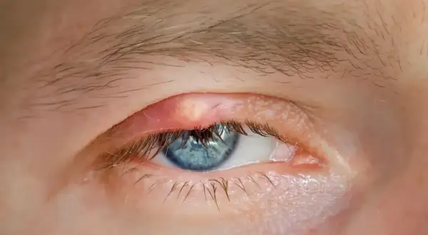 Żółtawy guzek na powiece, przypominający xanthelasma, obok niebieskiego oka.