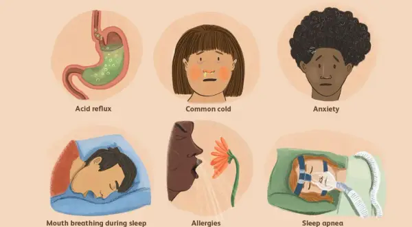 Illustration shows causes of dry throat: acid reflux, common cold, anxiety, mouth breathing during sleep, allergies, and sleep apnea.