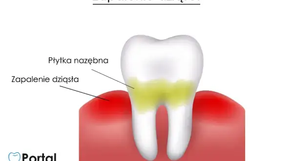 Co na dziąsła w ciąży? Skuteczne sposoby na zapalenie i ból