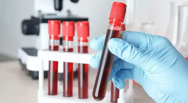 Lekarz lub diagnosta laboratoryjny może wystawić skierowanie na markery nowotworowe. W tle mikroskop i probówki z krwią.