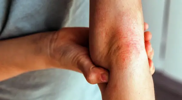 Armbeuge mit geröteter, schuppiger Haut, die stark juckt, typisch für Neurodermitis.