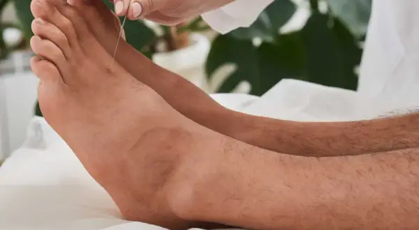 Une aiguille d'acupuncture est insérée sur le dessus du pied, ciblant un point d'acupuncture lié à l'estomac.