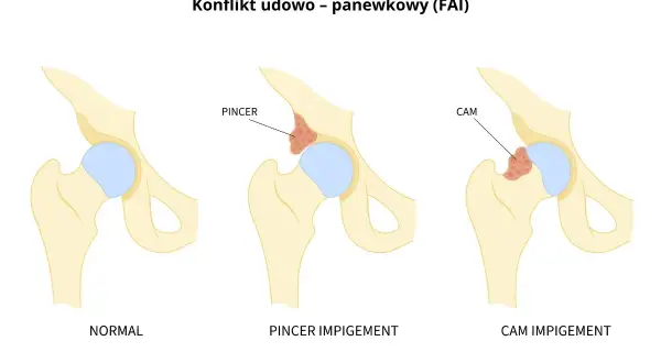 Ilustracja porównująca prawidłowe biodro z biodrem z konfliktem typu PINCER i CAM.