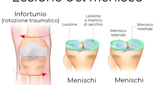 Illustrazione di un ginocchio con menisco lesionato a causa di un infortunio da rotazione. Confronto tra menischi sani e lesionati.