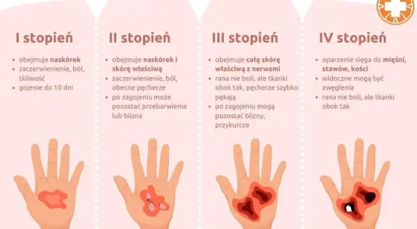 Co robić przy poparzeniu olejkiem eterycznym? Pierwsza pomoc i skuteczne sposoby leczenia