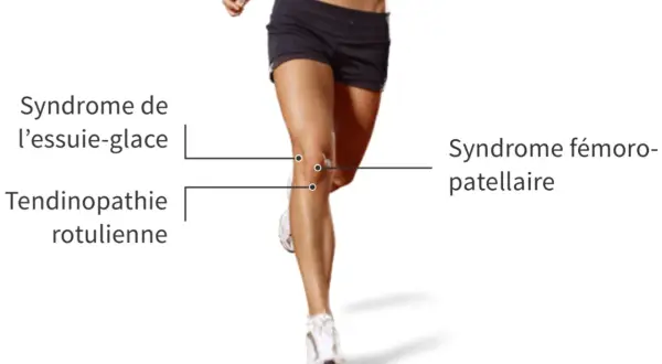 Jambes d'une coureuse, illustrant le syndrome de l'essuie-glace et la tendinopathie rotulienne, causant une douleur au genou externe.