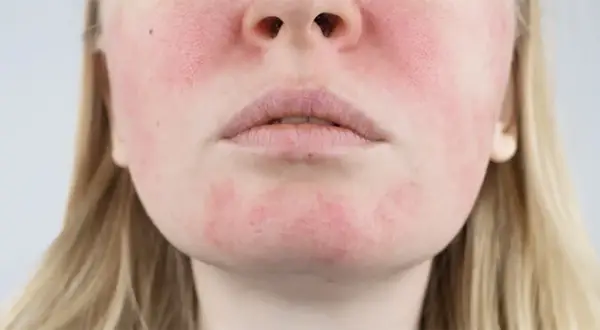 Primo piano del viso di una donna con pelle irritata e arrossata sulle guance e sul mento.