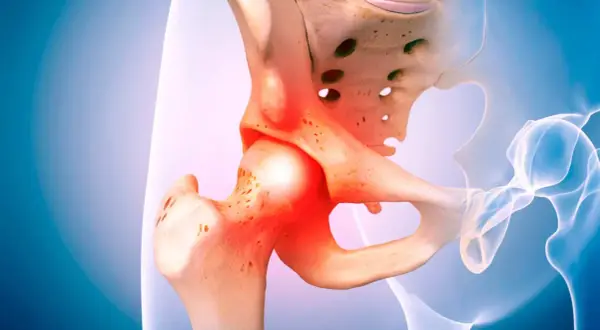 Anatomical illustration of a hip joint with inflamed areas indicating bolące biodra.