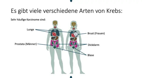 Abbildung zeigt, welche Krebsarten es gibt: Lunge, Prostata, Brust, Dickdarm und Blase sind häufige Karzinome.