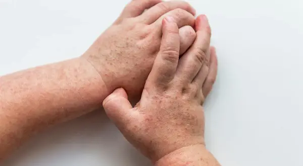 Dłonie z wysypką, która może być jednym z objawów HIV. Czerwone plamki na skórze.
