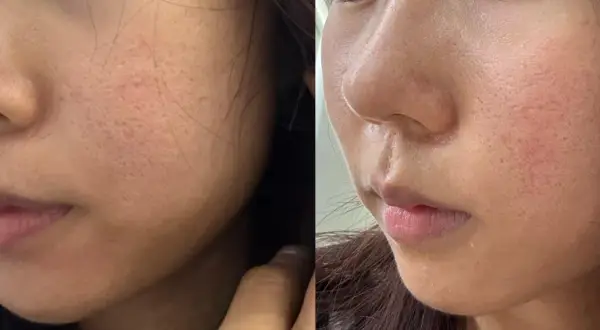 Split image showing a woman's cheek and nose area before and after fractional laser treatment, highlighting changes in skin texture and pore appearance.