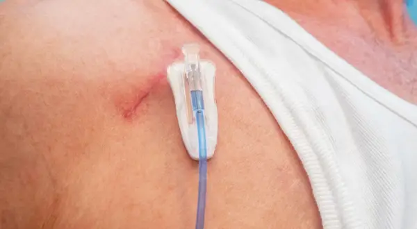Port-a-Cath für Chemotherapie: Ein Blick auf die Haut mit dem Zugangssystem.
