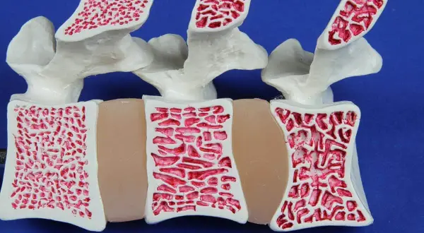 Model kręgosłupa z widoczną gąbczastą strukturą kości. Czy osteopenia może się cofnąć? Tak, przy odpowiednim leczeniu i stylu życia.