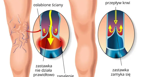 Ilustracja pokazuje nogę z widocznymi żylakami, porównując ją ze zdrową żyłą. Pokazuje, jak osłabione ściany i wadliwe zastawki prowadzą do zapalenia żył.