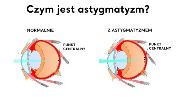 Astygmatyzm: Objawy, przyczyny i skuteczne metody korekcji