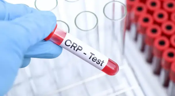 Ręka w niebieskiej rękawiczce trzyma probówkę z napisem "CRP - Test". To badanie pomaga ocenić stan zapalny w organizmie.