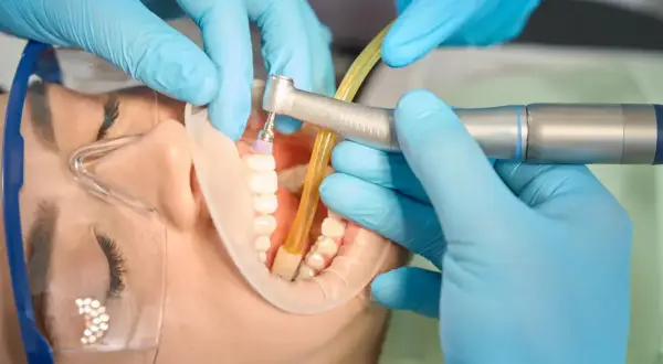 Dentysta wykonuje powtórne leczenie kanałowe, używając wiertła i ślinociągu. Pacjent ma założony koferdam i okulary ochronne.