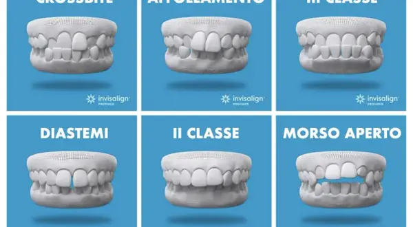 Sei casi di malocclusione dentale: crossbite, affollamento, III classe, diastemi, II classe, morso aperto. Soluzioni con mascherine invisalign.