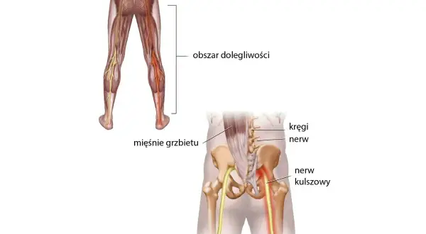 Anatomia bólu w dolnej części pleców i nogi, ilustrująca ucisk na nerw kulszowy, który powoduje objawy **sciatica po polsku**.