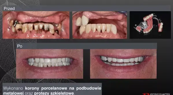 Szynowanie zębów: Na jak długo? Od urazu po paradontozę