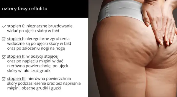 Cellulit na udach: Skuteczne sposoby na gładką skórę (Dieta, Ćwiczenia)