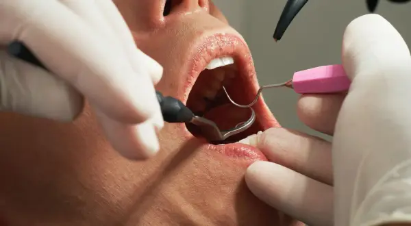 Dentysta używa lusterka i narzędzi do odbudowy zęba.