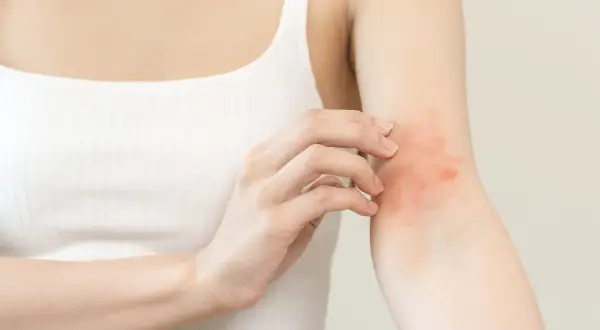 Frau kratzt sich am Arm mit rotem Ausschlag. Sie sucht nach Hausmittel gegen Juckreiz.