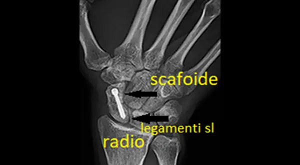 Radiografia del polso con vite nel scafoide mano, evidenziati radio e legamenti.