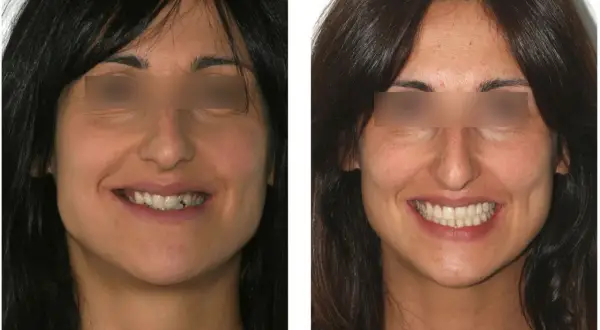 Sorriso prima e dopo: miglioramento estetico del canino incluso e dei denti.