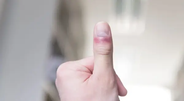 Zaczerwieniony, opuchnięty palec z siniakiem pod paznokciem. Wygląda na to, że doszło do postrzału palca.