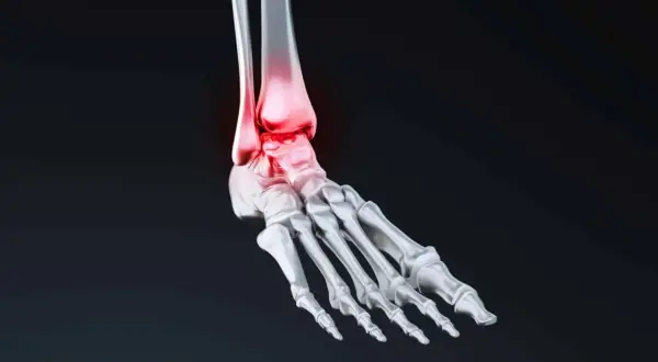 Anatomie du pied humain, mettant en évidence l'astragale os et les zones enflammées en rouge.