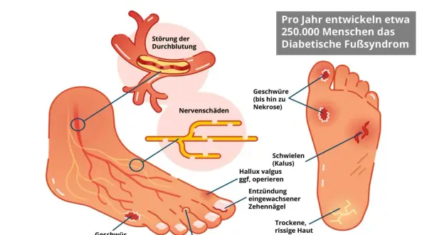 Illustration zeigt einen Fuß mit Anzeichen des diabetischen Fußsyndroms: Geschwüre, Nervenschäden und Durchblutungsstörungen. Ein kleiner Zeh zeigt erste Anzeichen.