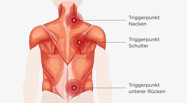 Muskelansicht des Rückens mit markierten Triggerpunkten im Nacken, an der Schulter und im unteren Rücken, die auf hws myogelose hinweisen.