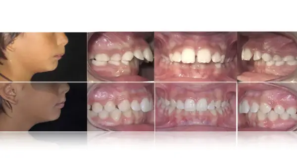 Prima e dopo: profilo di un bambino con apparecchio denti sporgenti e immagini ravvicinate dei suoi denti prima e dopo il trattamento ortodontico.