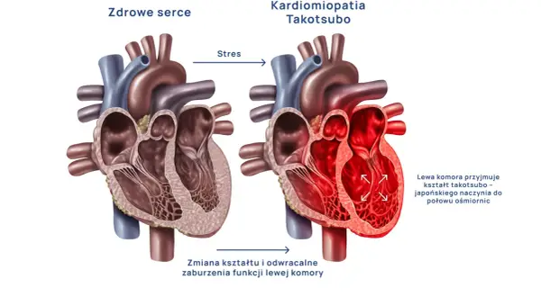 Zdrowe serce kontra kardiomiopatia Takotsubo, czyli zespół złamanego serca. Stres powoduje zmianę kształtu lewej komory.